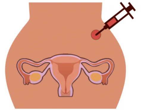 国内代生哪里找,去马来西亚做三代试管的真实案例有吗哪个试友可以分享一下